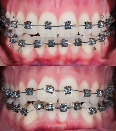 two photos showing mouth of a person wearing braces.
