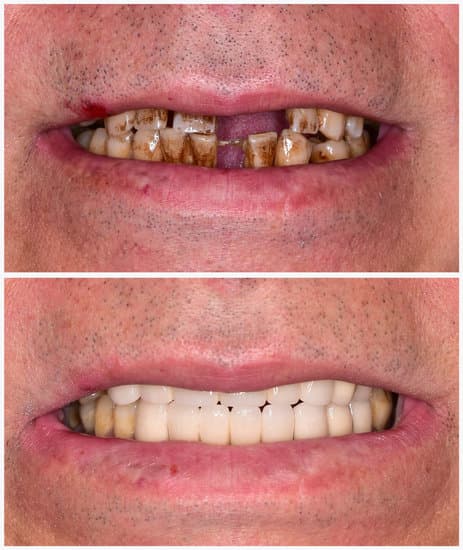 two photos shown. One on top shows image of a person's teeth which are missing and stained. The lower photo shows all teeth replaced with dentures